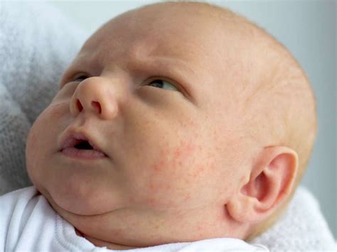 Baby acne vs. eczema: How to tell the difference