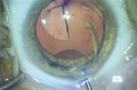 CRSToday | IOL Properties: Considerations for Lens Removal