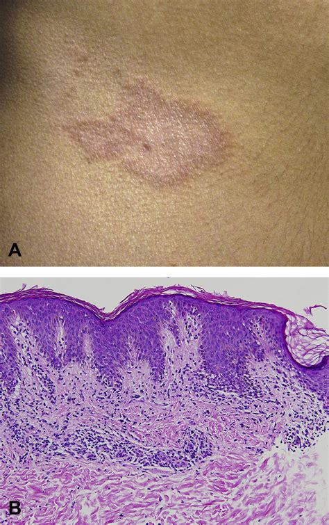 Annular lichenoid dermatitis of youth in an American boy - Journal of the American Academy of ...