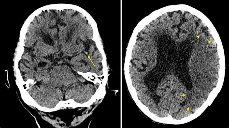 Acute MCA infarct - dot sign - Radiology at St. Vincent's University ...