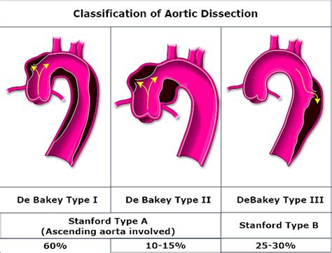 Aortic Dissection Cross Section