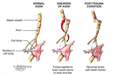 Diffuse Axonal Injury - Google Search | Tramatic brain injury, Brain injury, Traumatic brain injury