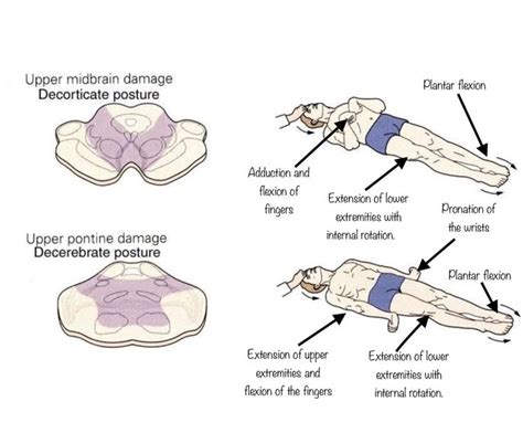 Decorticate and Decerebrate Posturing: What does it really tell us ...