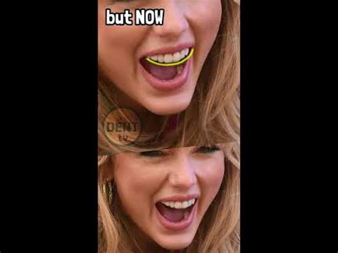 Taylor Swift teeth then and now: before and after surgery tooth ...