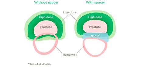 Spacers for prostate cancer radiation therapy | GenesisCare AU