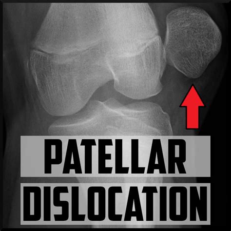 Patellar Dislocation: Introduction and Diagnosis - Sports Medicine Review