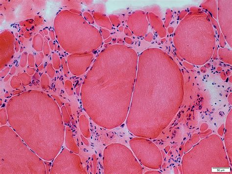 FSH Dystrophy