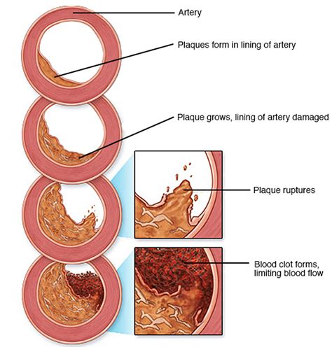 Myocardial Ischemia - Causes, Diagnosis, Symptoms, Treatment