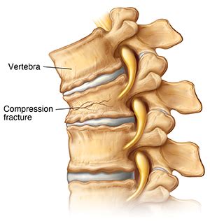 Back Fracture (Compression Fracture) | Saint Luke's Health System