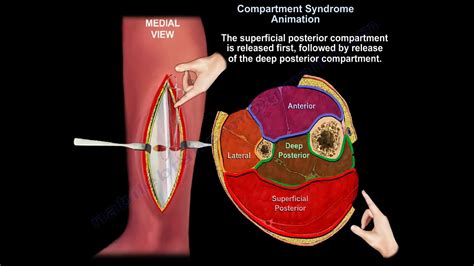 Acute and chronic leg Compartment Syndrome - Everything You Need To ...