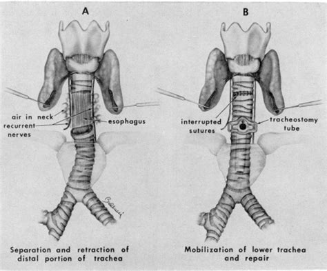 Figure 4 from Reconstruction of the Larynx following Blunt Trauma | Semantic Scholar