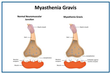 Myasthenia Gravis: Symptoms, Causes, Treatment & Risk Factors