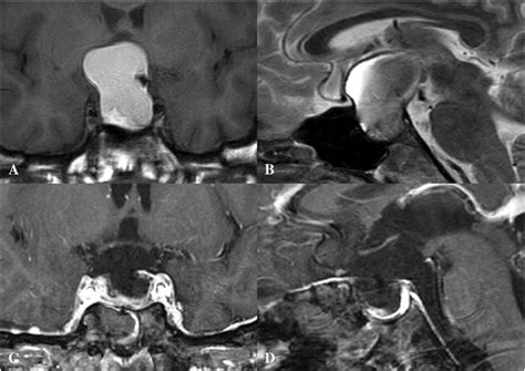 MR imaging of Case 9 revealing a large tumor compressing the optic... | Download Scientific Diagram