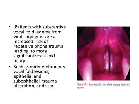 Disease of larynx