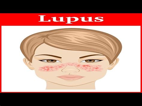 Get free and Say Goodby to Lupus with Rapid Health Recovery System