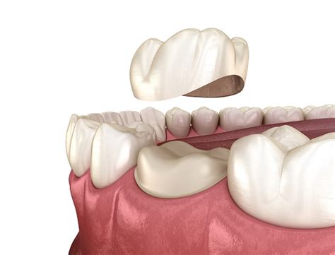 What Happens During a Dental Crown Procedure - TTH Family Dentistry ...