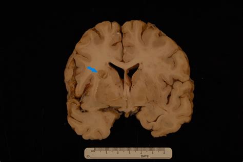 Brain autopsy gross section. Multiple tan-yellow circumscribed ...