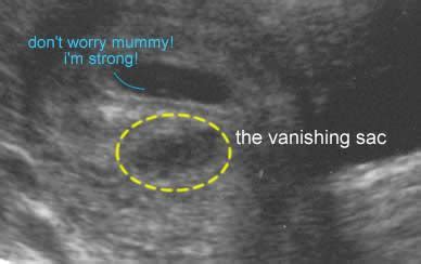 Ultrasound of vanishing twin, which results in only one live birth. | Vanishing twin syndrome ...