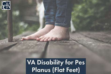 VA Disability Ratings for Pes Planus (Flat Feet) Explained | CCK Law