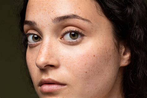 Understanding Melasma: Causes, Treatments, and Prevention - Skincentral