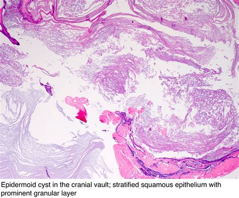 Pathology Outlines - Epidermal (epidermoid) type