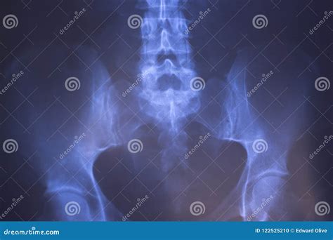 Medical Xray Spine Hip Scan Stock Photo - Image of medical, bone: 122525210