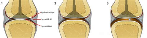 What may be causing the cracking sound of a synovial joint