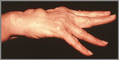 Rheumatoid Arthritis Symptoms : Johns Hopkins Arthritis Center