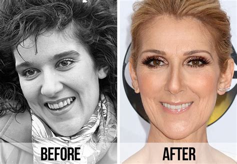 21 Celebrity Dental Implants And Veneers: Before And After - SHEfinds