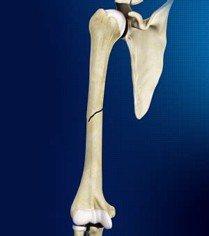 Midshaft Humerus Fracture Spring, TX | Elbow Fracture Montgomery County, TX