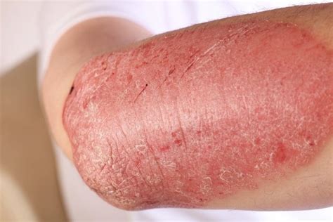 Psoriasis: Symptoms, Types, Causes & Treatment - Tua Saúde