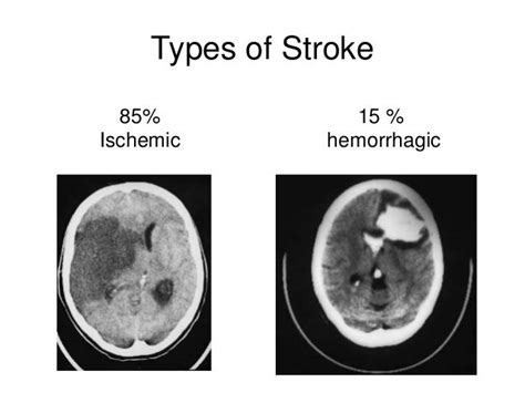 ct to distinguish hemorrhagic vs ischemic stroke - Google Search | Types of strokes, Strokes ...