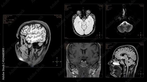 Head MRI scan from different angles. Top view and side view of brain ...