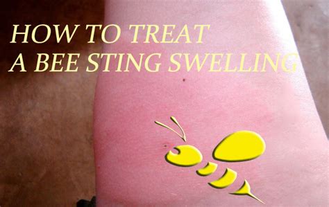 How To Get Rid Of Bee Stings - Crazyscreen21