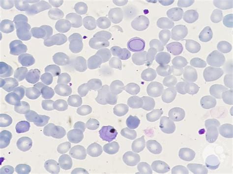 Cabot rings in a patient with Myelofibrosis