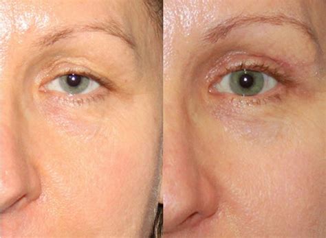 Eyelid Surgery - Upper & Lower, Blepharoplasty Surgery, Recovery