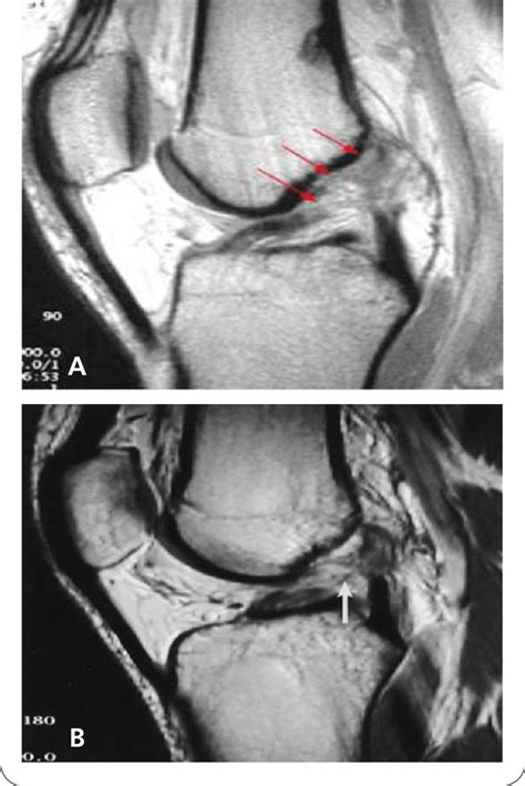 Knee MRI images a) partial tear of ACL appear as increased signal ...