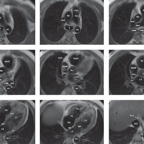 (PDF) Cardiac Imaging: Part 1, MR Pulse Sequences, Imaging Planes, and Basic Anatomy