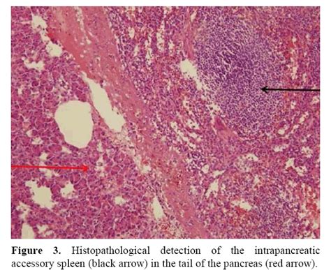 Intrapancreatic Accessory Spleen. A Case Report and Review of Lit