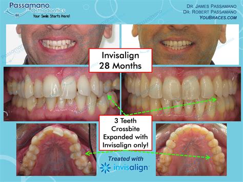 Braces & Invisalign Smile Gallery - Passamano Orthodontics - Irvine CA