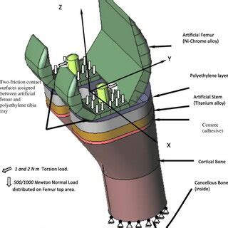 Constituents of artificial knee joint. | Download Scientific Diagram