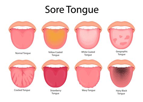 Illustration of tongue symptoms and health. medical illustration ...