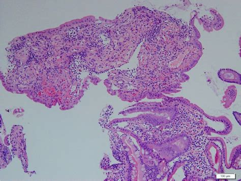 Pathology Outlines - Portal hypertensive gastropathy