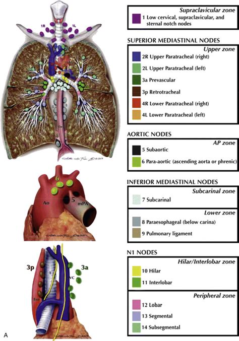 Mediastinum: Lymph Node Abnormalities and Masses | Radiology Key