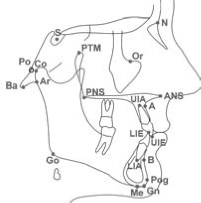 The major landmarks used in McNamara’s analysis. Nasion (N), sella (S),... | Download Scientific ...