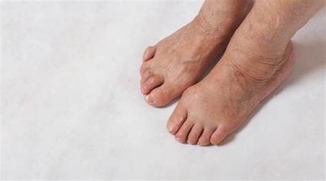 Claw Toes sign of underlying diabetes, says doctors | Lifestyle News,The Indian Express