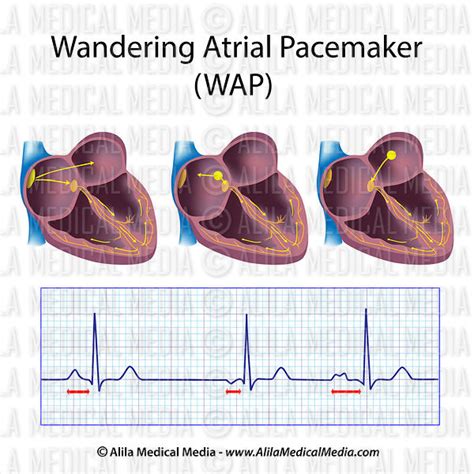 What Is A Wandering Atrial Pacemaker With Pictures Images And Photos | The Best Porn Website