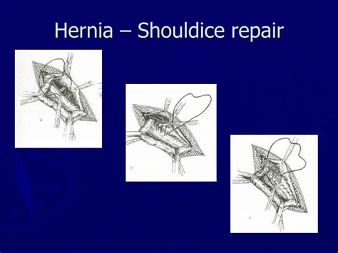 PPT - Hernia PowerPoint Presentation, free download - ID:2306551