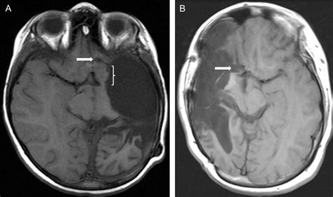 Fifty Consecutive Hemispherectomies - Neurosurgery Blog