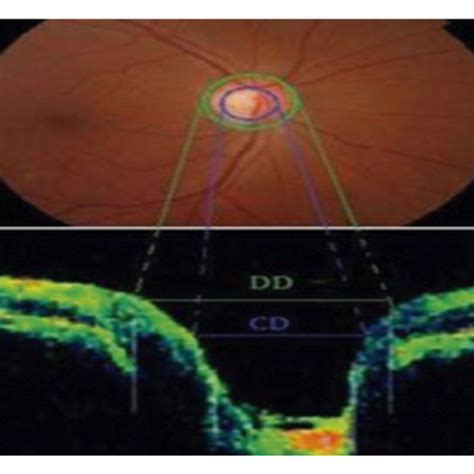 An OCT image. (a) Small cup-to-disc diameter ratio in the normal... | Download Scientific Diagram